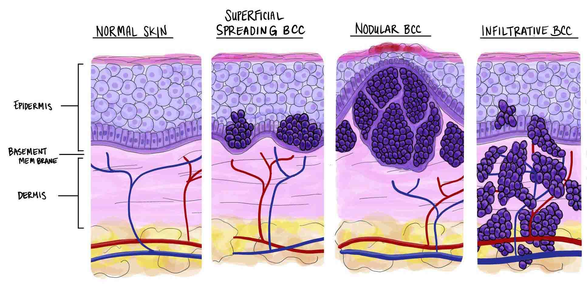 ung thư biểu mô tế bào đáy